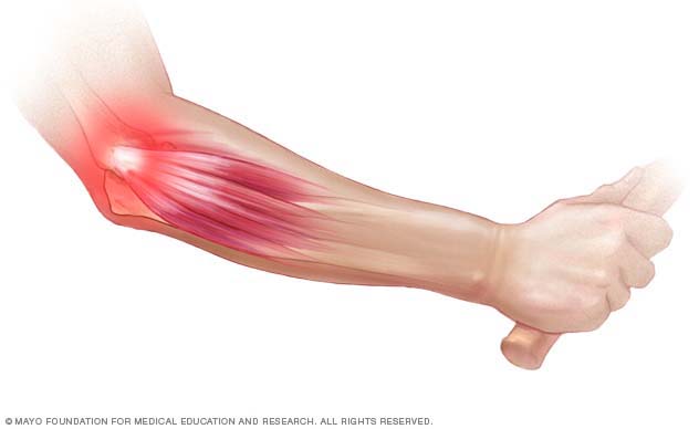 What is the standard treatment for arm pain?